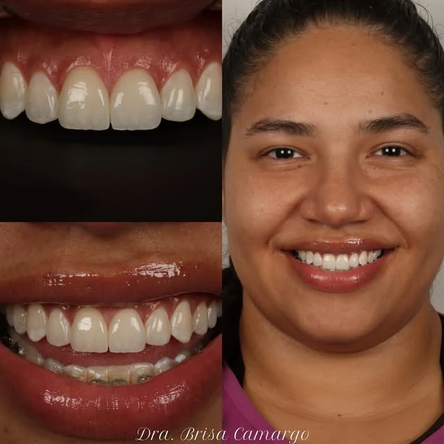 Transformação do sorriso de uma paciente real da clínica